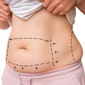 Abdominoplastia-min